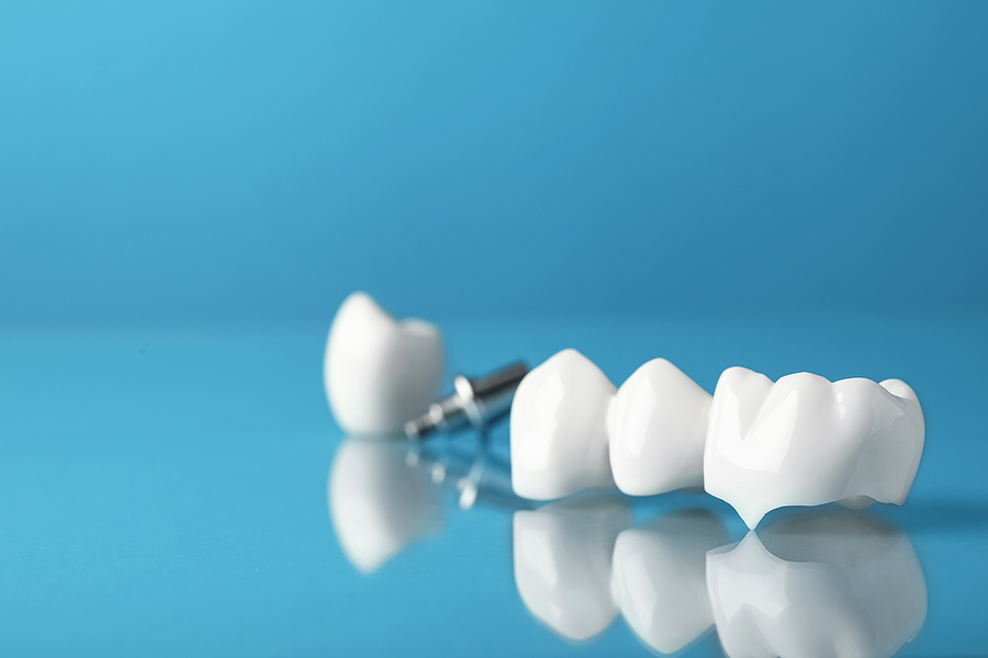 How Dental Crowns Protect Your Natural Teeth