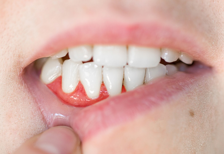 What Are the Causes of Gum Disease?
