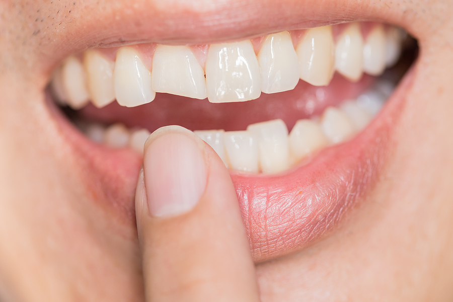 Effective Solutions for Cracked Tooth Repair in Baton Rouge, LA